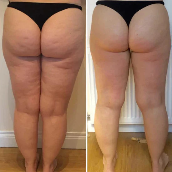 Zendoza Anti-Cellulite Massager