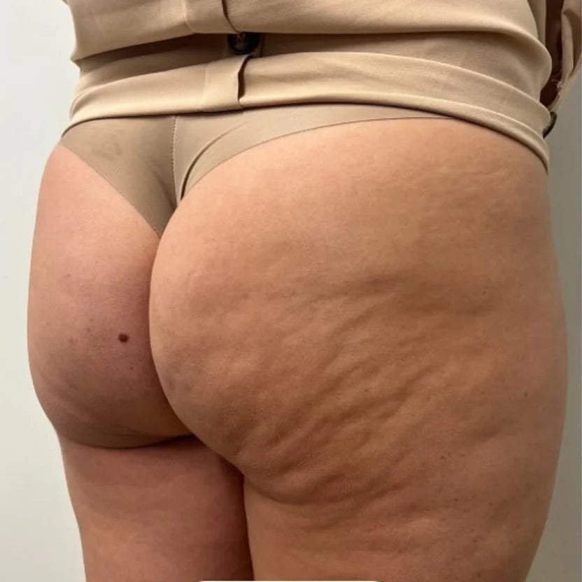 Zendoza Anti-Cellulite Massager